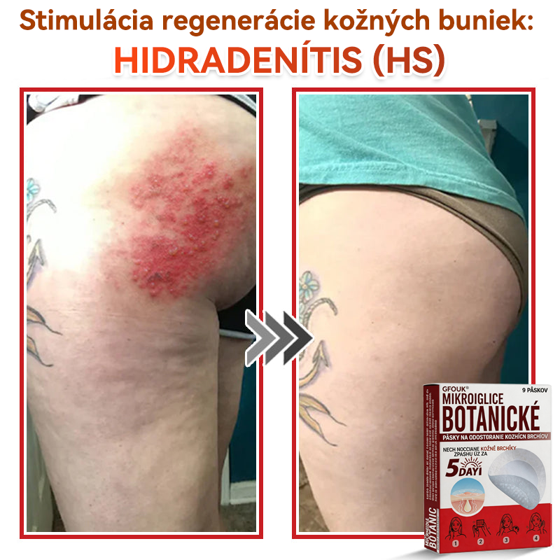 💕✅GFOUK® MicroNeedle botanic náplasť na odstránenie kožných výrastkov Vyrobené