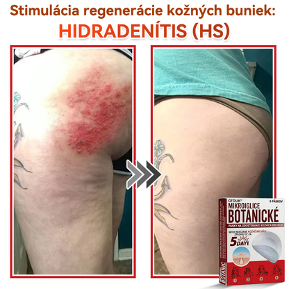 💕✅GFOUK® MicroNeedle botanic náplasť na odstránenie kožných výrastkov Vyrobené