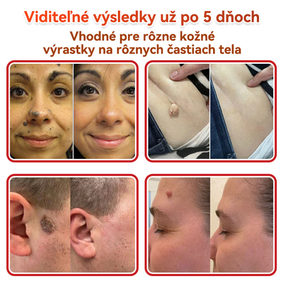 💕✅GFOUK® MicroNeedle botanic náplasť na odstránenie kožných výrastkov Vyrobené