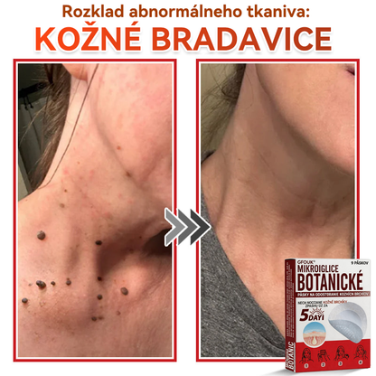 💕✅GFOUK® MicroNeedle botanic náplasť na odstránenie kožných výrastkov Vyrobené