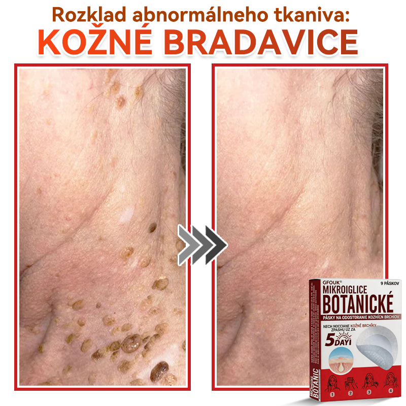 💕✅GFOUK® MicroNeedle botanic náplasť na odstránenie kožných výrastkov Vyrobené