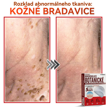 💕✅GFOUK® MicroNeedle botanic náplasť na odstránenie kožných výrastkov Vyrobené