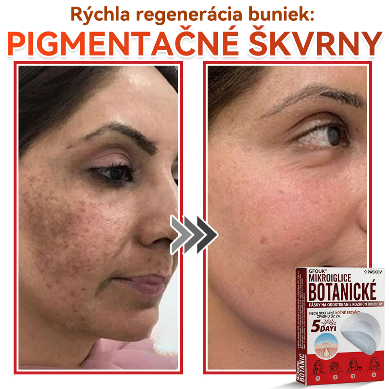 💕✅GFOUK® MicroNeedle botanic náplasť na odstránenie kožných výrastkov Vyrobené